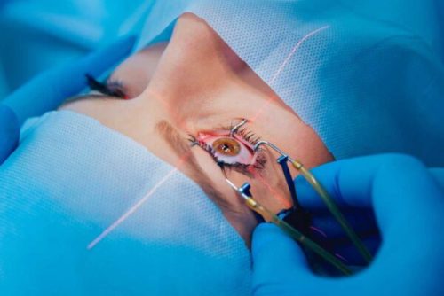 cirugia-laser-600x409