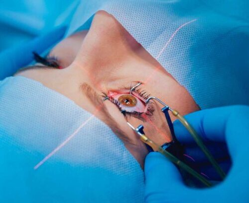 cirugia-laser-600x409