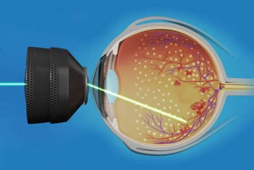 fotocoagulacion-500x334